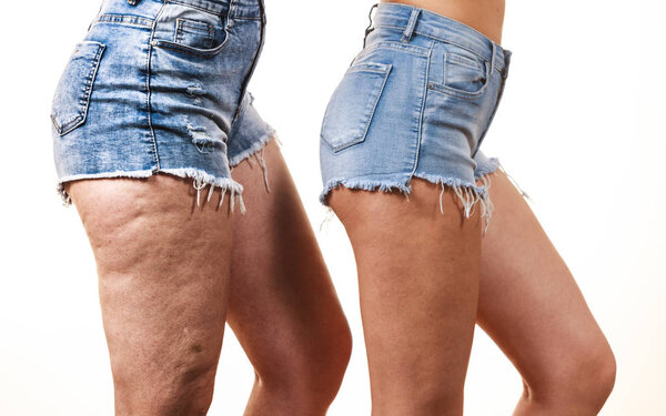 Сравнение бедер женских ног с целлюлитом и без него. Проблема кожи, уход за телом, избыточный вес и диета.