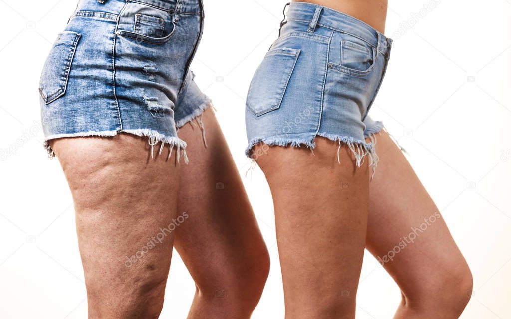 Comparison of female legs thighs with and without cellulite. Skin problem, body care, overweight and dieting concept.