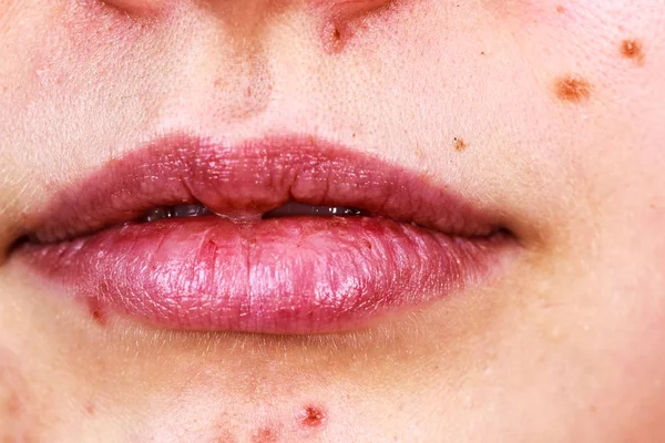 年轻女人脸上露出粉刺 痣和干裂的嘴唇 少女的下巴上没有红斑 没有化妆 健康问题 皮肤病 — 图库照片
