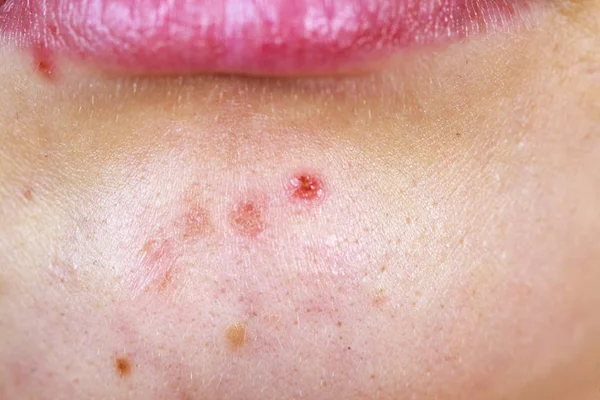 Mulher Jovem Mostrando Seu Rosto Com Acne Toupeiras Lábios Secos — Fotografia de Stock