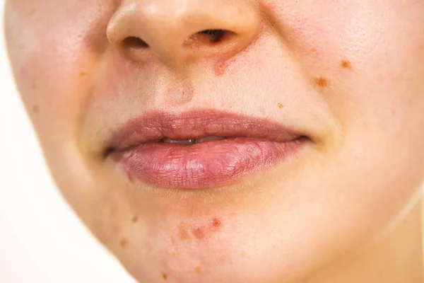 Cara femenina con acné problema de la piel — Foto de Stock