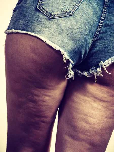 セルライト肌を持つ女性の足 — ストック写真