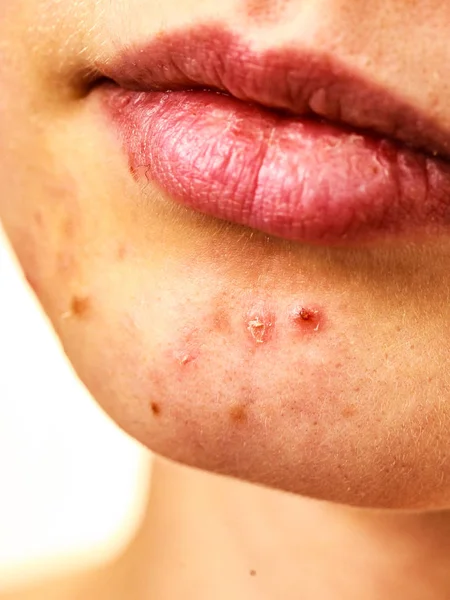 Rosto feminino com problema de pele acne — Fotografia de Stock