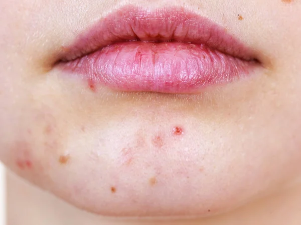Wajah wanita dengan masalah kulit jerawat — Stok Foto