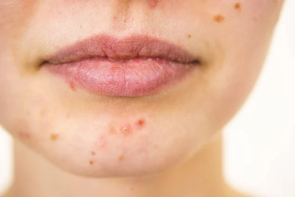 Cara femenina con acné problema de la piel — Foto de Stock