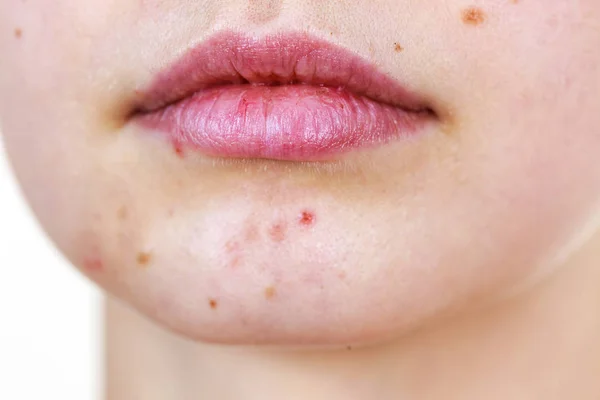 Twarz kobiety z problemem trądziku skóry — Zdjęcie stockowe