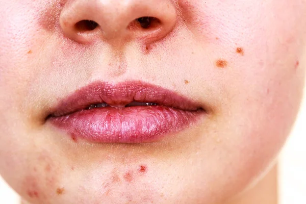 にきびの肌の問題を持つ女性の顔 — ストック写真