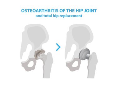 Osteoartrit kalça eklemi ve kalça protezi ameliyatı tıbbi Infographic öğeleri beyaz arka plan üzerinde izole. Artrit ve yapay bir ortak ile metalden yapılmış değiştirir ile ortak.