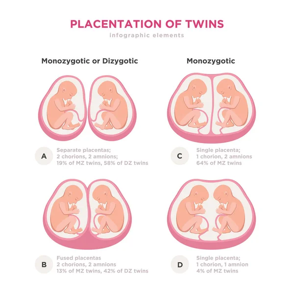 Dos tipos de elementos infográficos de diseño plano. Colocación monocigótica o dicigótica de gemelos ilustración médica e iconos aislados sobre fondo blanco . — Archivo Imágenes Vectoriales