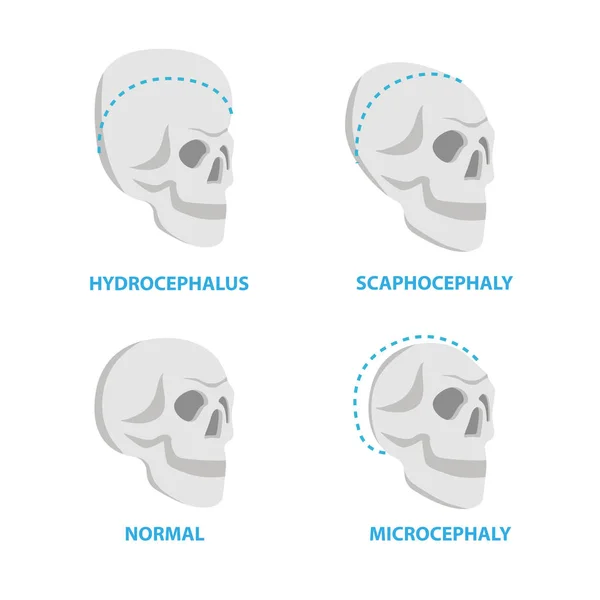 Conjunto de cráneos normal y deforme, hidrocefalia, escafocefalia, microcefalia vector iconos planos, ilustraciones médicas cráneo, elementos anatómicos infográficos aislados sobre fondo blanco . — Vector de stock