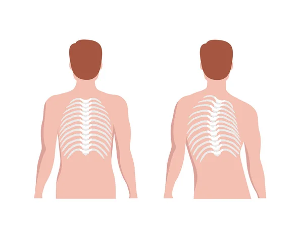 Scoliosi toracica sulla colonna vertebrale toracica e dritto concetto spina dorsale illustrazione vettoriale in disegno piatto isolato su sfondo bianco. Elementi infografici medici della scoliosi, silhouette maschile — Vettoriale Stock