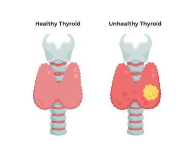Sağlıklı Tiroid bezi ve inflamasyon ve yumru ile sağlıksız tiroid, tiroid kanseri kavramı, düz illüstrasyon beyaz arka plan üzerinde izole. Tıbbi infografik elemanlar.