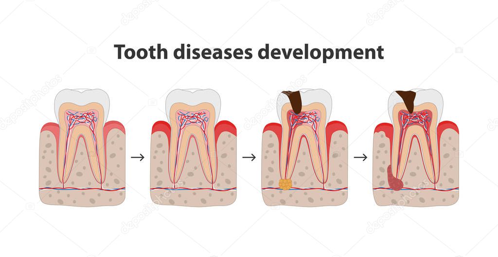 Development of tooth disease medical poster illustration in flat design. Teeth in gum icons isolated on white background.