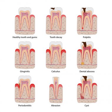 Düz tasarım popüler diş hastalıkları simgeleri, vektör tıbbi illüstrasyon. Diş ortak sorunları infografik elemanları beyaz arka plan izole. Anatomik simgelerin sağlıklı ve sağlıksız dişler seti.