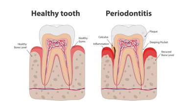 Sağlıklı diş ve sağlıklı olmayan diş periodontitis ile diş eti iltihabı infografik elemanları beyaz arka plan izole. Düz tasarımtıbbi diş poster illüstrasyon.