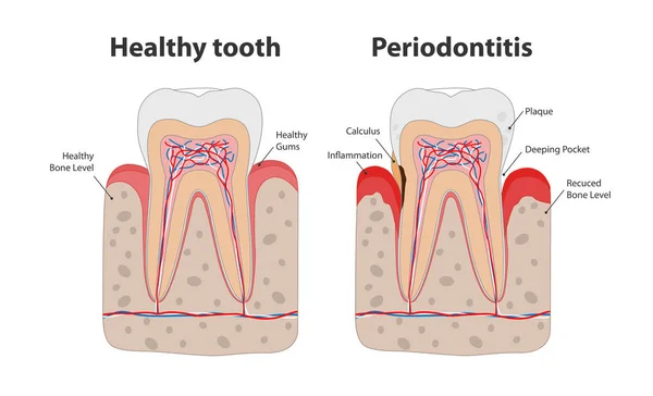 Zdravý zub a nezdravý zub s periodontitis s zánětčovanými, infmatgrafickými prvky izolovanými na bílém pozadí. Lékařský zubní plakát ilustrace v plochém designu. — Stockový vektor