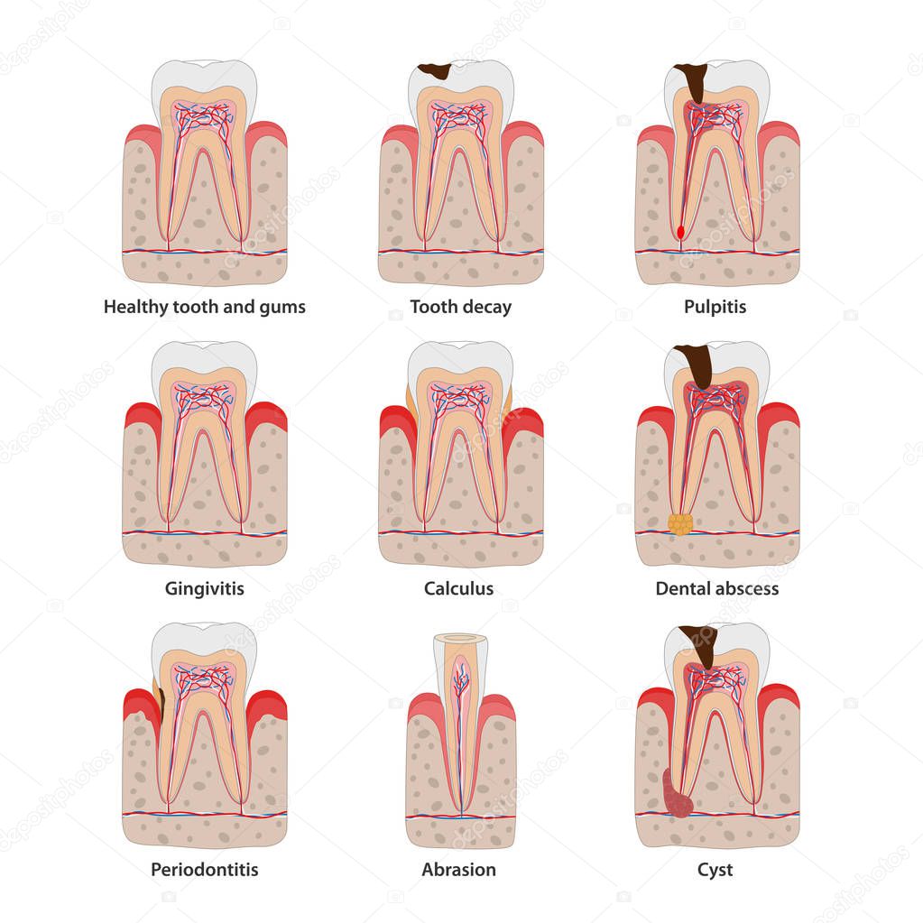 Popular teeth diseases icons in flat design, vector medical illustration. Dental common problems infographic elements isolated on white background. Healthy and unhealthy teeth set of anatomical icons.