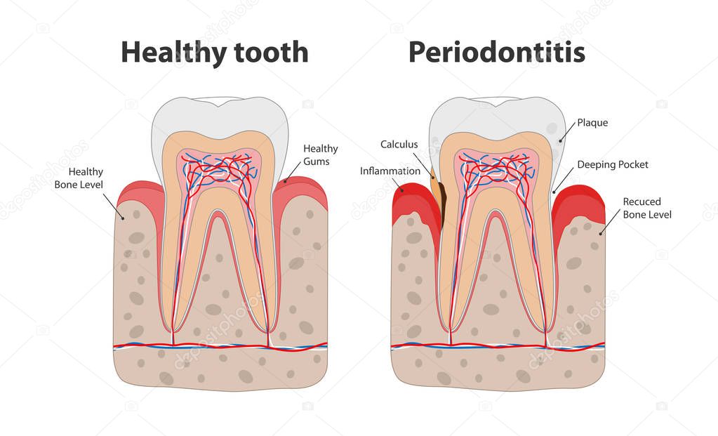 Healthy tooth and unhealthy tooth with periodontitis with gum inflammation infographic elements isolated on white background. Medical dental poster illustration in flat design.
