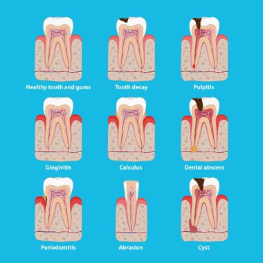 Düz tasarım popüler diş hastalıkları simgeleri, vektör tıbbi illüstrasyon. Diş problemleri infografik elemanları izole. Sağlıklı ve sağlıksız dişler, diş çürümesi, minber, periodontit, kalkülüs.