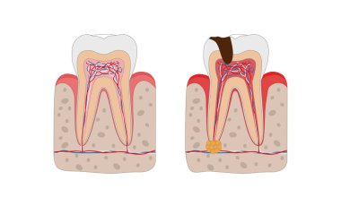 Healthy tooth and unhealthy tooth with tooth decay and dental abscess infographic elements isolated on white background. Medical dental poster illustration in flat design. clipart