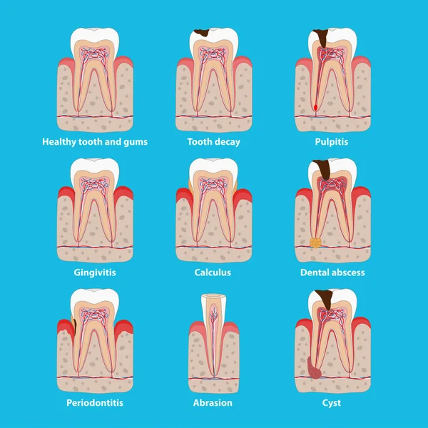 Populární ikony zubů v plochém designu, vektorová lékařská ilustrace. Zubní problémy izolované. Zdravé a nezdravé zuby, zubní rozklad, pulpitis, periodontitis, kalkulus. — Stockový vektor
