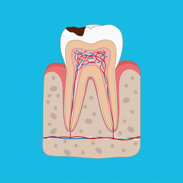 Anatomie nezdravého zubu se zubním útlumem izolovaným křížem. Lékařský zubní plakát ilustrace v plochém designu. — Stockový vektor