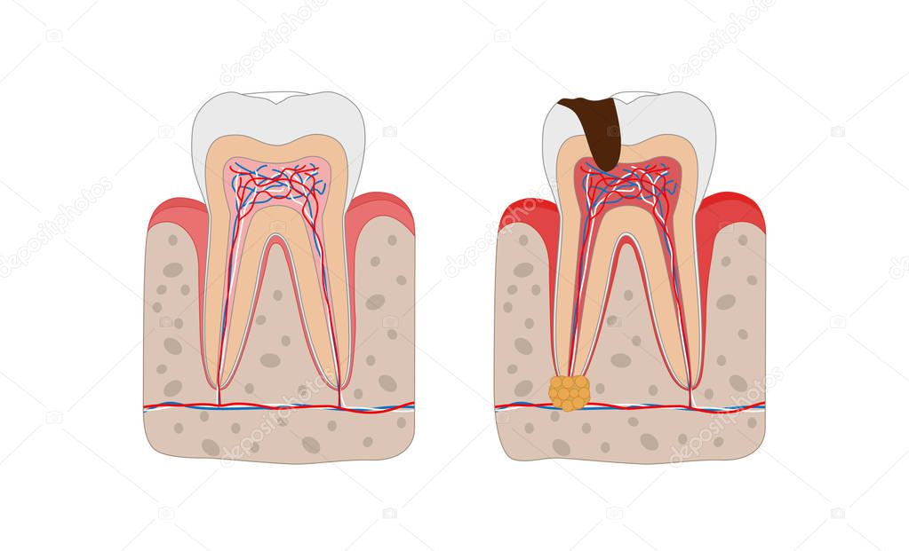 Healthy tooth and unhealthy tooth with tooth decay and dental abscess infographic elements isolated on white background. Medical dental poster illustration in flat design.