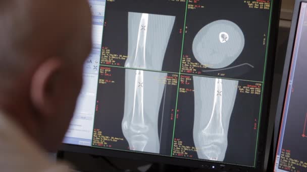 Fotky z kostní scan na monitoru. — Stock video