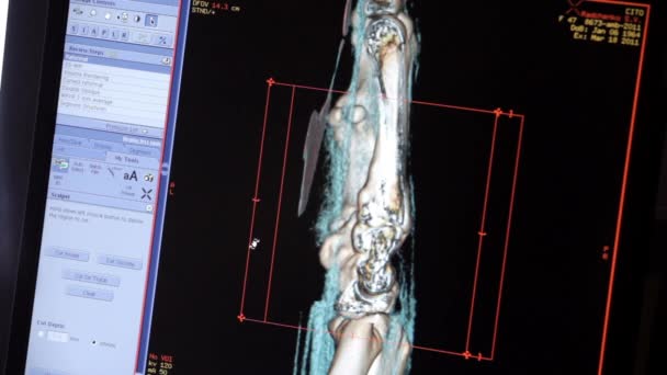 Pictures of the bone scan on the monitor. — Stock Video