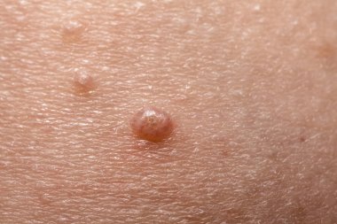 Molluscum Contagiosum Ayrıca su siğil parçası dediği kısmı yakın çekim