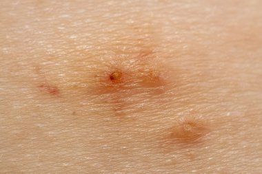 Molluscum Contagiosum Ayrıca su siğil parçası dediği kısmı yakın çekim