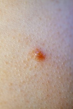 Molluscum Contagiosum Ayrıca su siğil parçası dediği kısmı yakın çekim