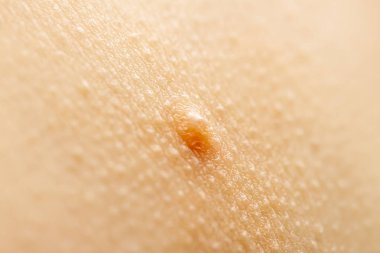 Molluscum Contagiosum Ayrıca su siğil parçası dediği kısmı yakın çekim
