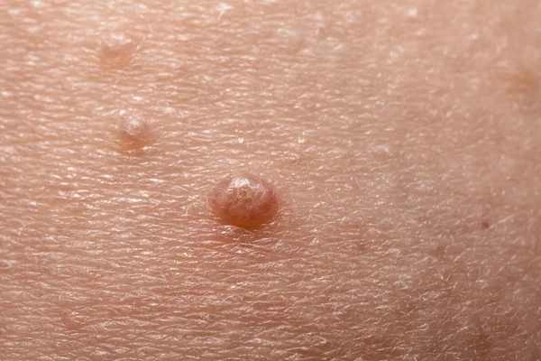 Close up van Molluscum Contagiosum water wrat een afkorting — Stockfoto