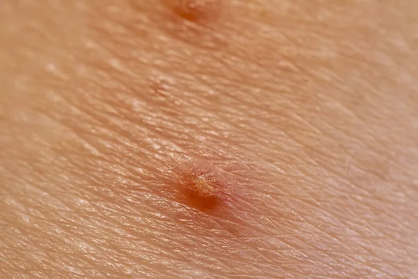 Primer plano de Molluscum Contagiosum también llamado verruga de agua — Foto de Stock