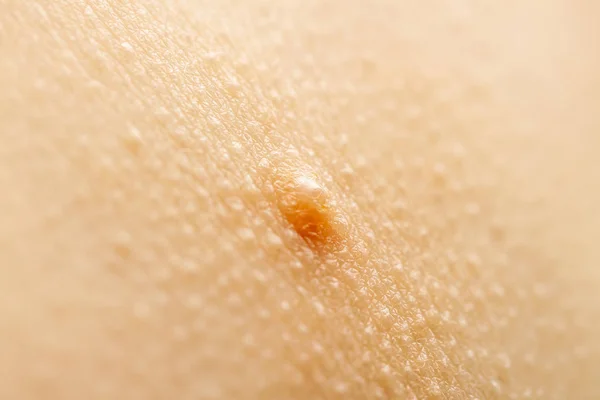 Close up of Molluscum Contagiosum also called water wart — Stock Photo, Image