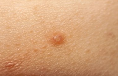 Molluscum Contagiosum Ayrıca su siğil parçası dediği kısmı yakın çekim