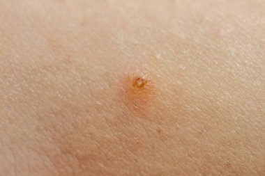 Molluscum Contagiosum Ayrıca su siğil parçası dediği kısmı yakın çekim