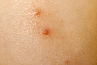 Molluscum Contagiosum Ayrıca su siğil parçası dediği kısmı yakın çekim