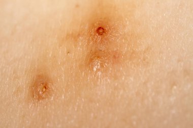 Molluscum Contagiosum Ayrıca su siğil parçası dediği kısmı yakın çekim