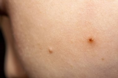 Molluscum Contagiosum Ayrıca su siğil parçası dediği kısmı yakın çekim