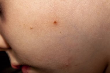 Molluscum Contagiosum Ayrıca su siğil parçası dediği kısmı yakın çekim