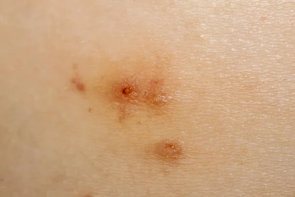 Primer plano de Molluscum Contagiosum también llamado verruga de agua — Foto de Stock