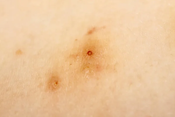 水いぼとも呼ばれる伝染性軟属腫のクローズ アップ — ストック写真