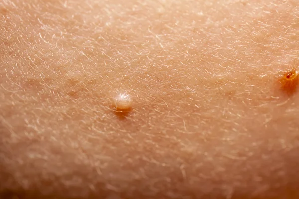 Close up van Molluscum Contagiosum water wrat een afkorting — Stockfoto