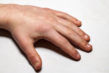 El ısırıldı parmak ve tırnakları ile yakın çekim.