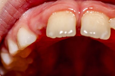 Close-up bebek dişlerini tedavi - kalıcı süt dişleri, sonra 10 ay kaybetme değil sorun ile sekiz yıllık çocuk da süt dişleri ameliyat çıkardıktan sonra köpekbalığı hastalığı - denir