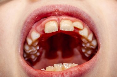 Close-up bebek dişlerini tedavi - kalıcı süt dişleri, sonra 10 ay kaybetme değil sorun ile sekiz yıllık çocuk da süt dişleri ameliyat çıkardıktan sonra köpekbalığı hastalığı - denir