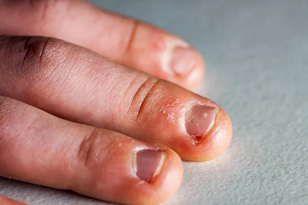 Primo piano della mano con dito morso e unghie . — Foto Stock