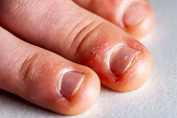Close-up van de hand met gebeten vinger en nagels. — Stockfoto
